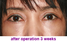 plastic-surgery-blepharoplasty